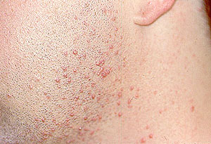 Steroid dose for skin rash