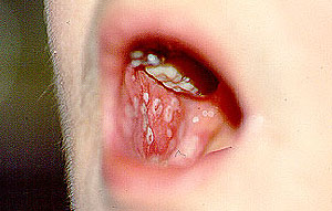 Oral candidiasis caused by inhalation steroids