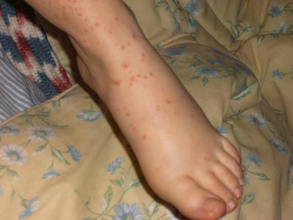 red rash on top of feet #10