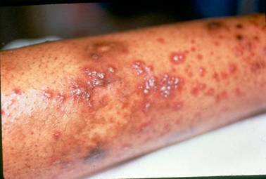 What does it mean if you have a purpura rash?