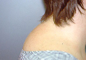 Steroid induced striae