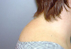 Back Neck Fat 94