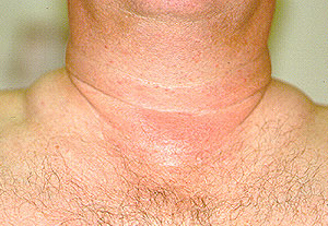 Steroids facial swelling