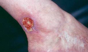 Human skin wound dressings to treat cutaneous ulcers