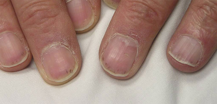 What are those little white marks on your fingernails 