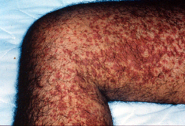 henoch schonlein purpura arthritis