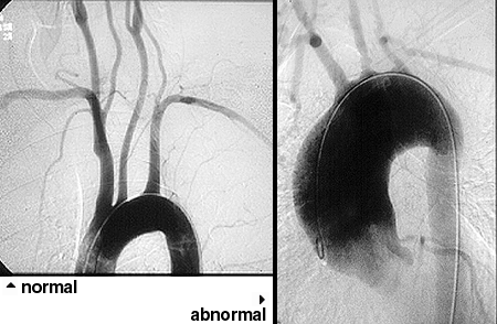 Takayasu's Arteritis : Johns Hopkins Vasculitis Center