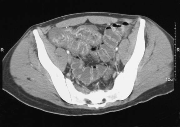 Image result for gastrointestinal vasculitis