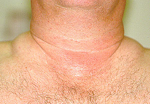 prednisone hump buffalo neck causes vasculitis lupus center area dose