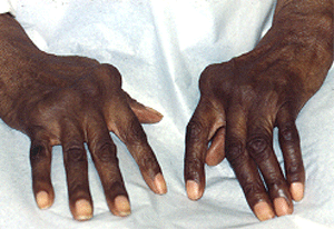 rheumatoid_hands-image-1.gif
