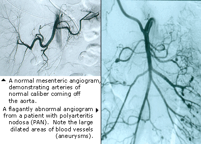 angiogram