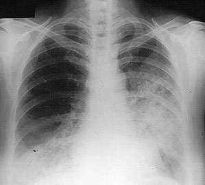 Chest Xray