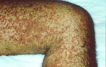 What are causes of leaking veins in the legs?